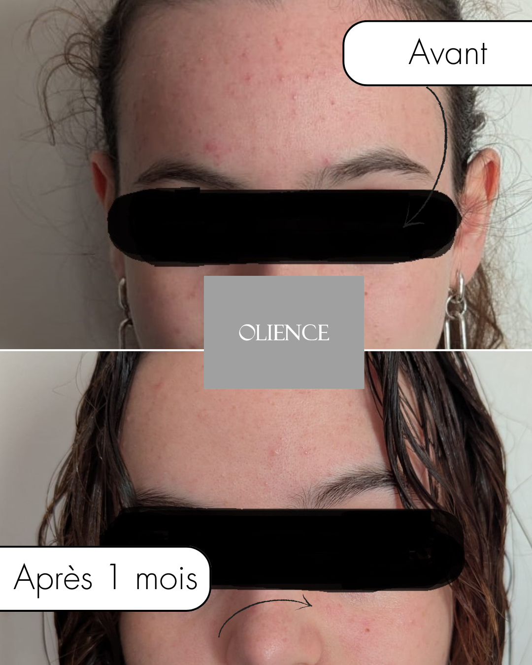 après 1 mois - Elyna site